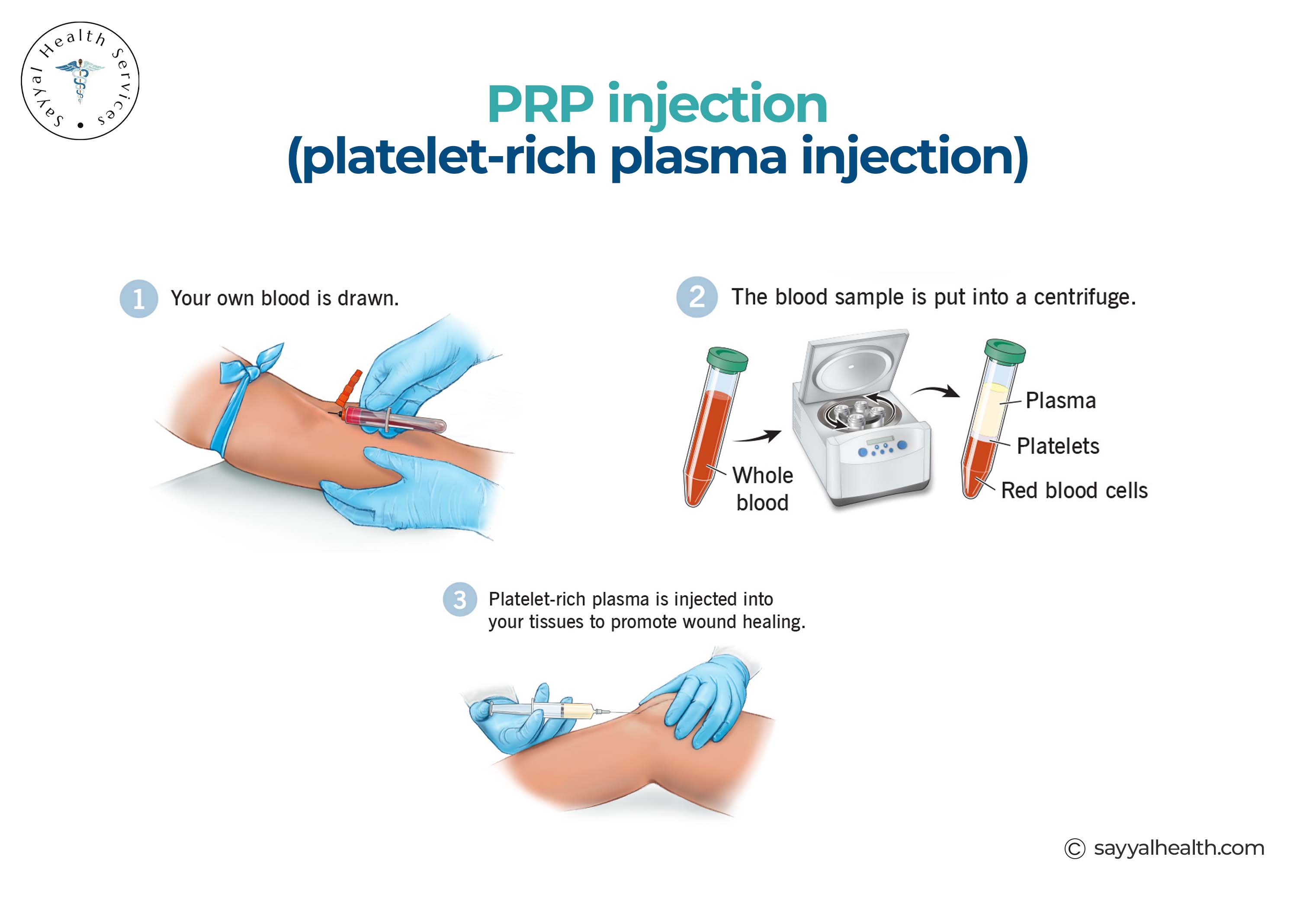 What to Expect During a PRP Injection?