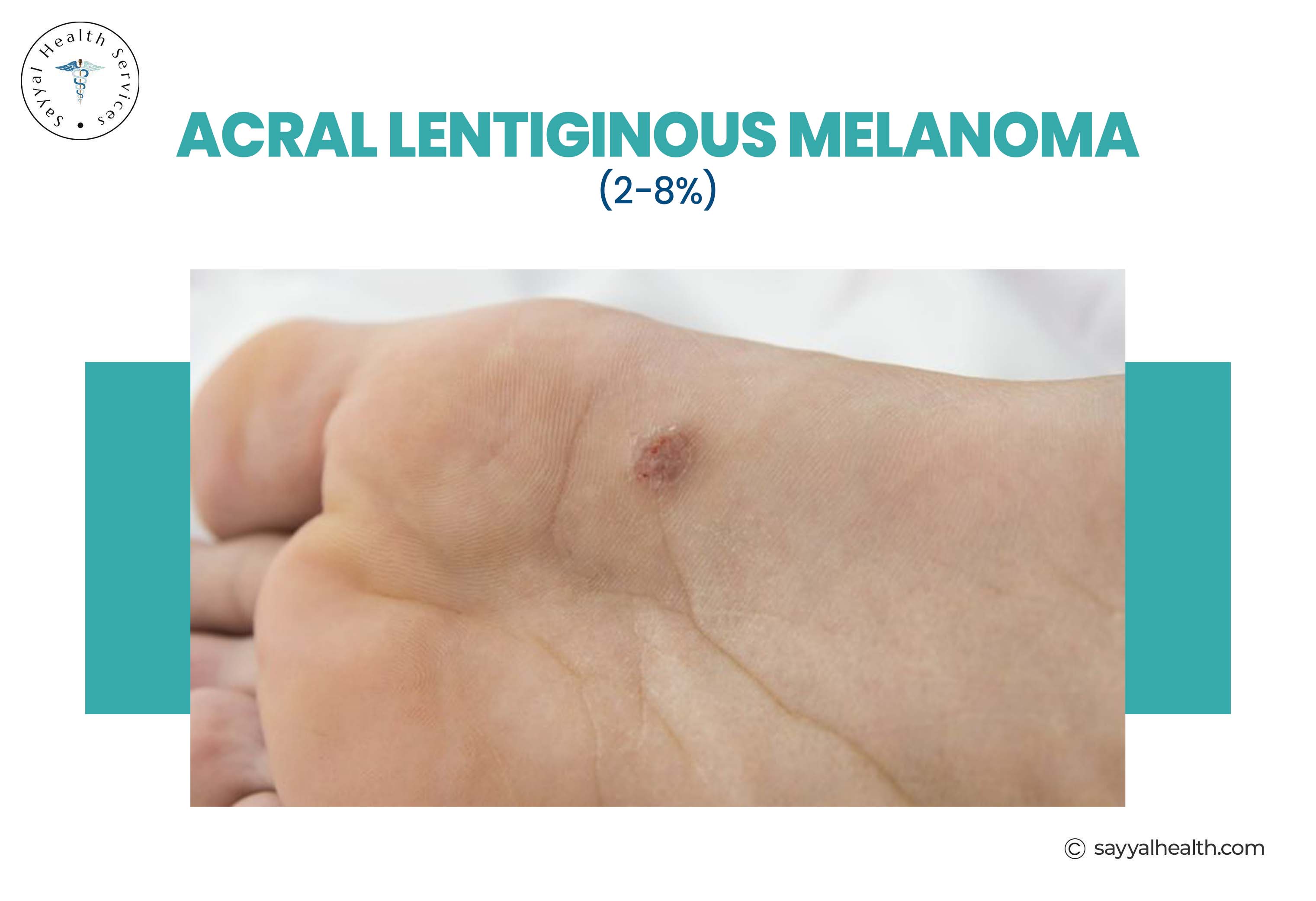 ABCDE Melanoma: A Simple Guide to Early Detection
