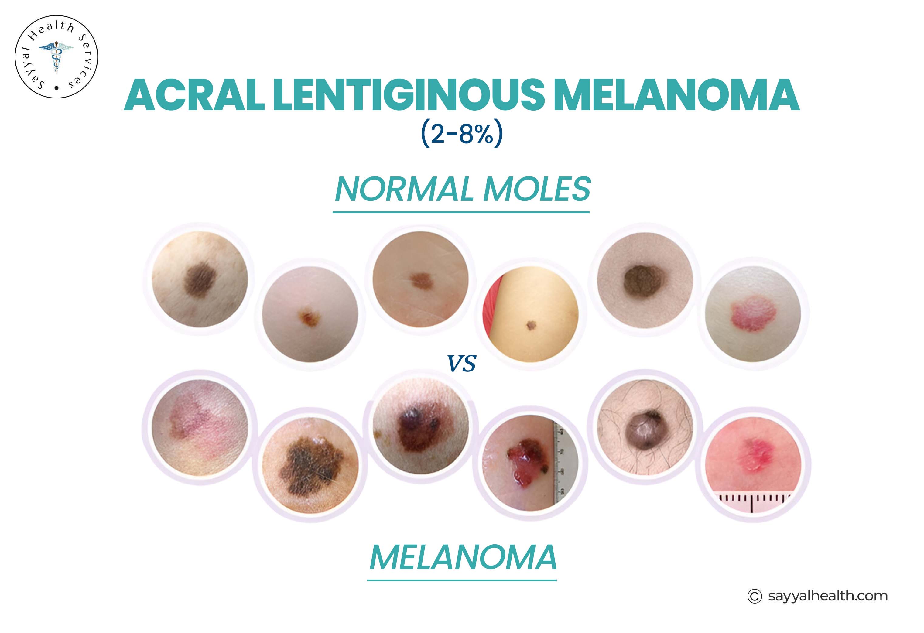 ABCDE Melanoma: A Simple Guide to Early Detection