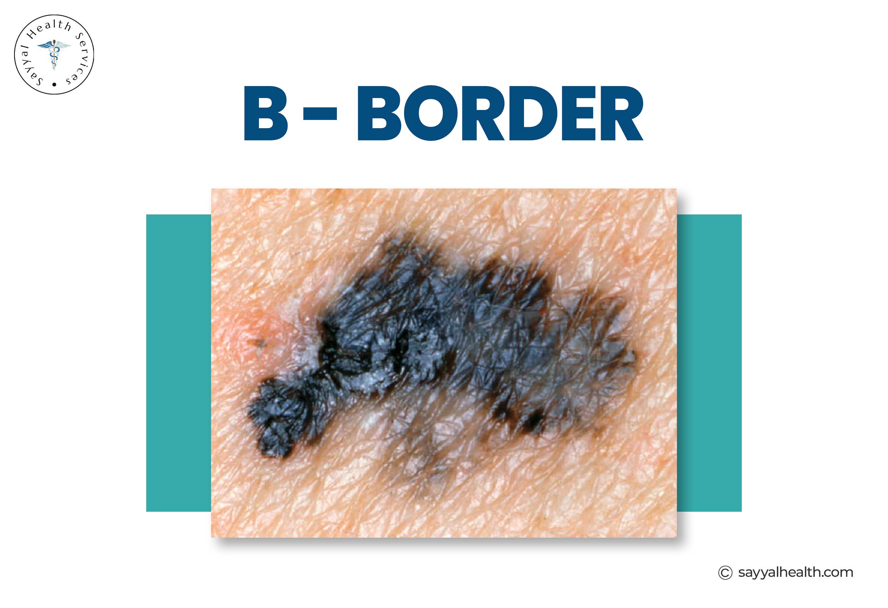 ABCDE Melanoma: A Simple Guide to Early Detection