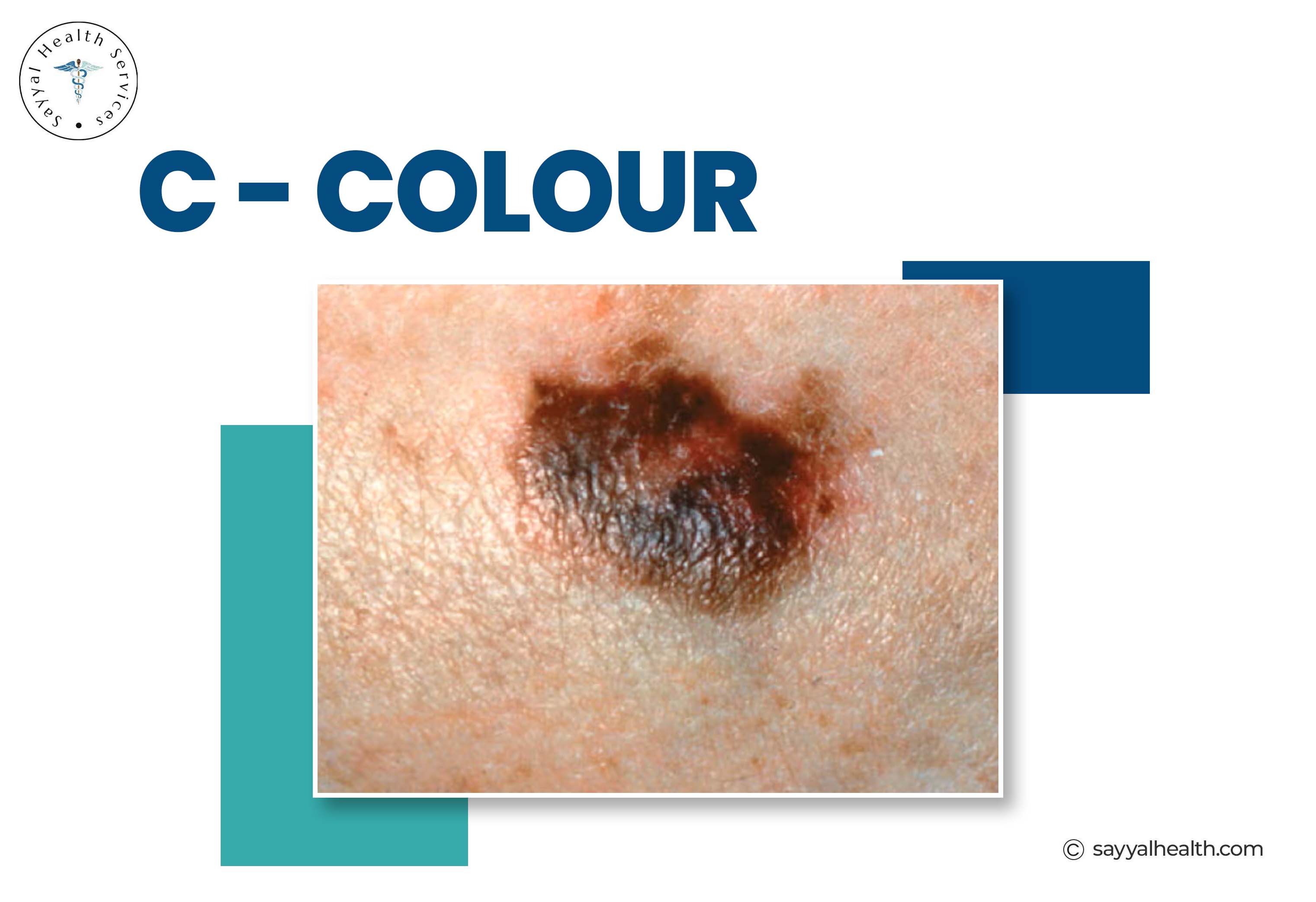 ABCDE Melanoma: A Simple Guide to Early Detection
