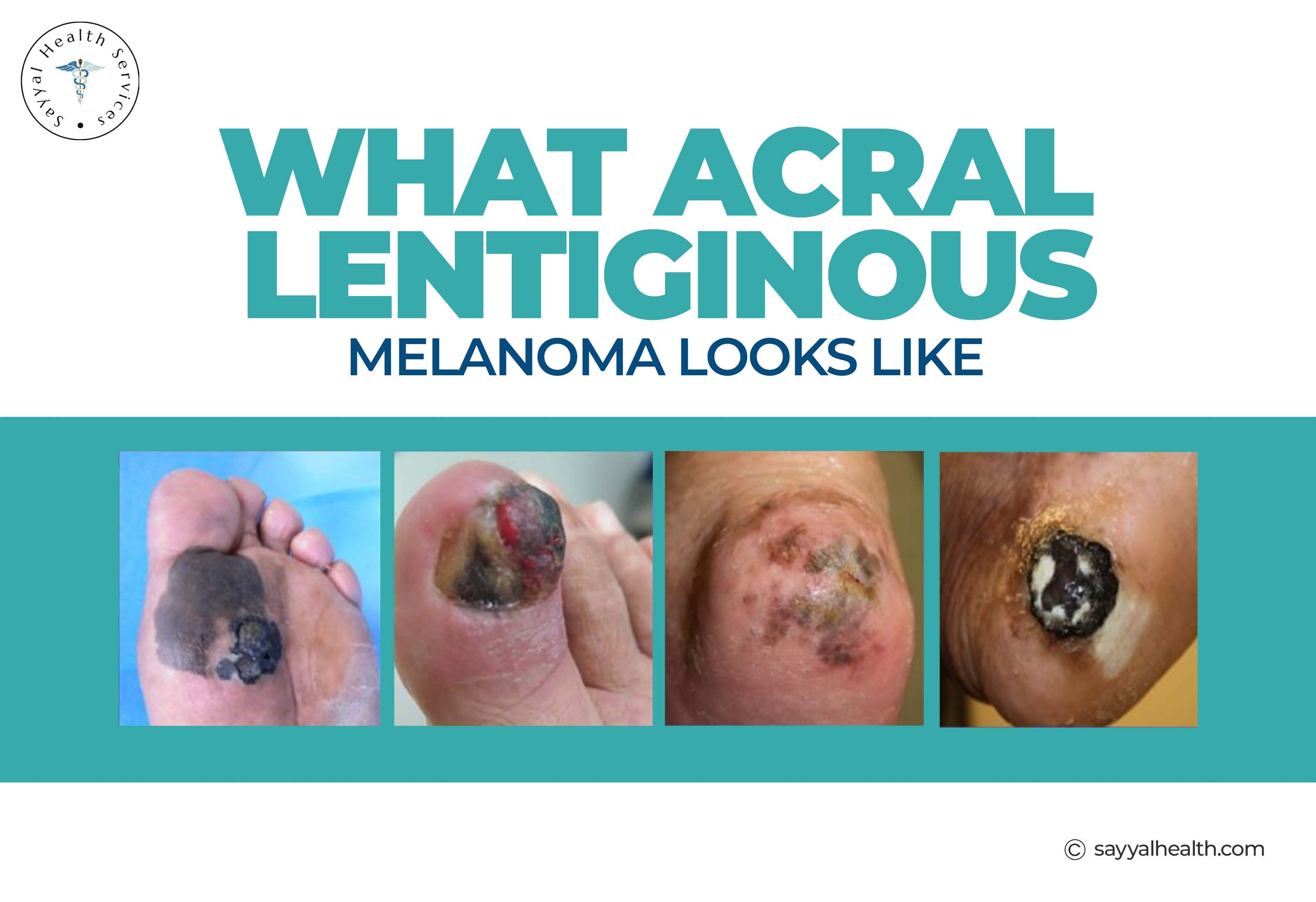 Acral Lentiginous Melanoma: Symptoms, Causes & Diagnosis