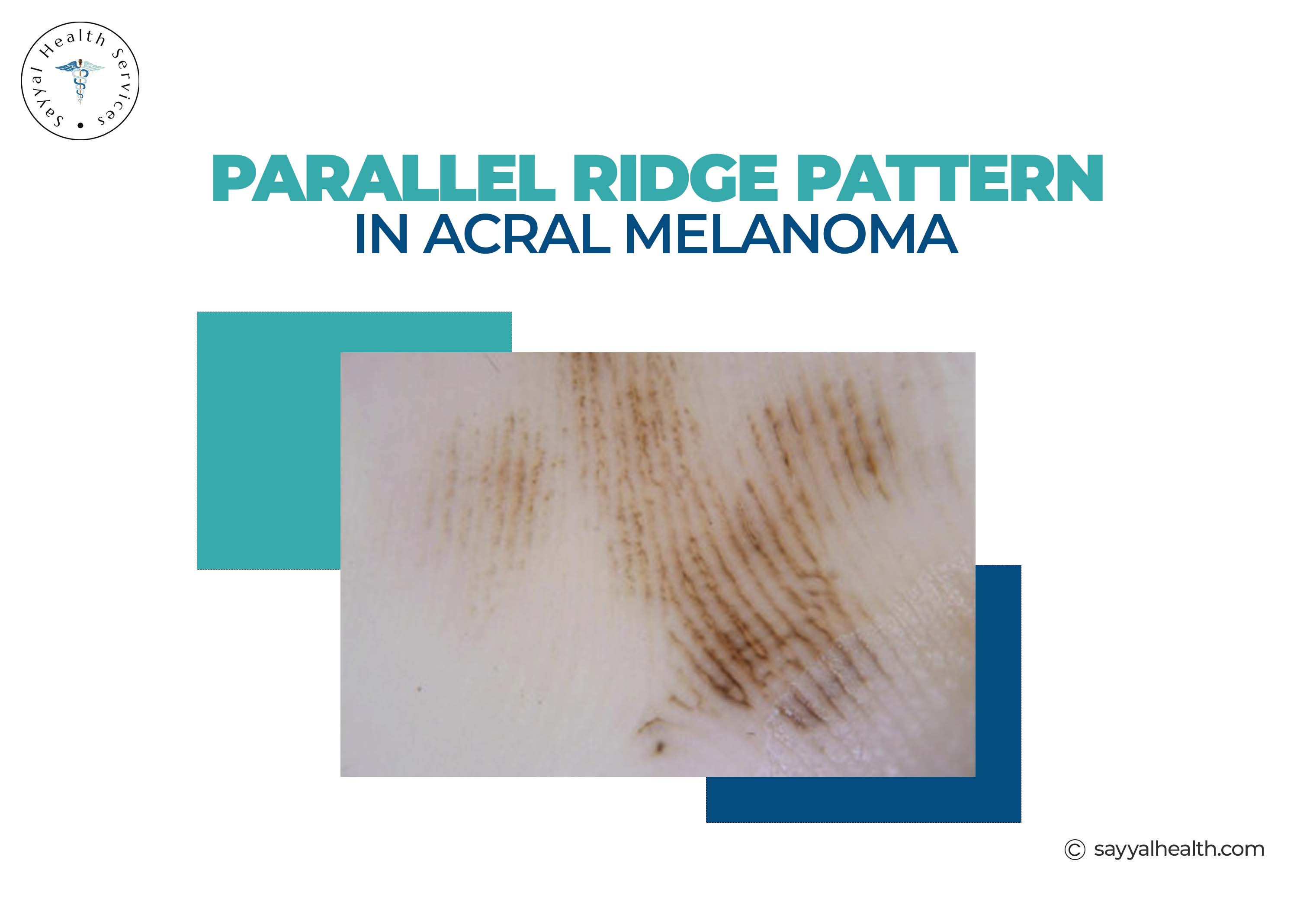 The Parallel Ridge Pattern Acral Lentiginous Melanoma: Symptoms, Causes & Diagnosis