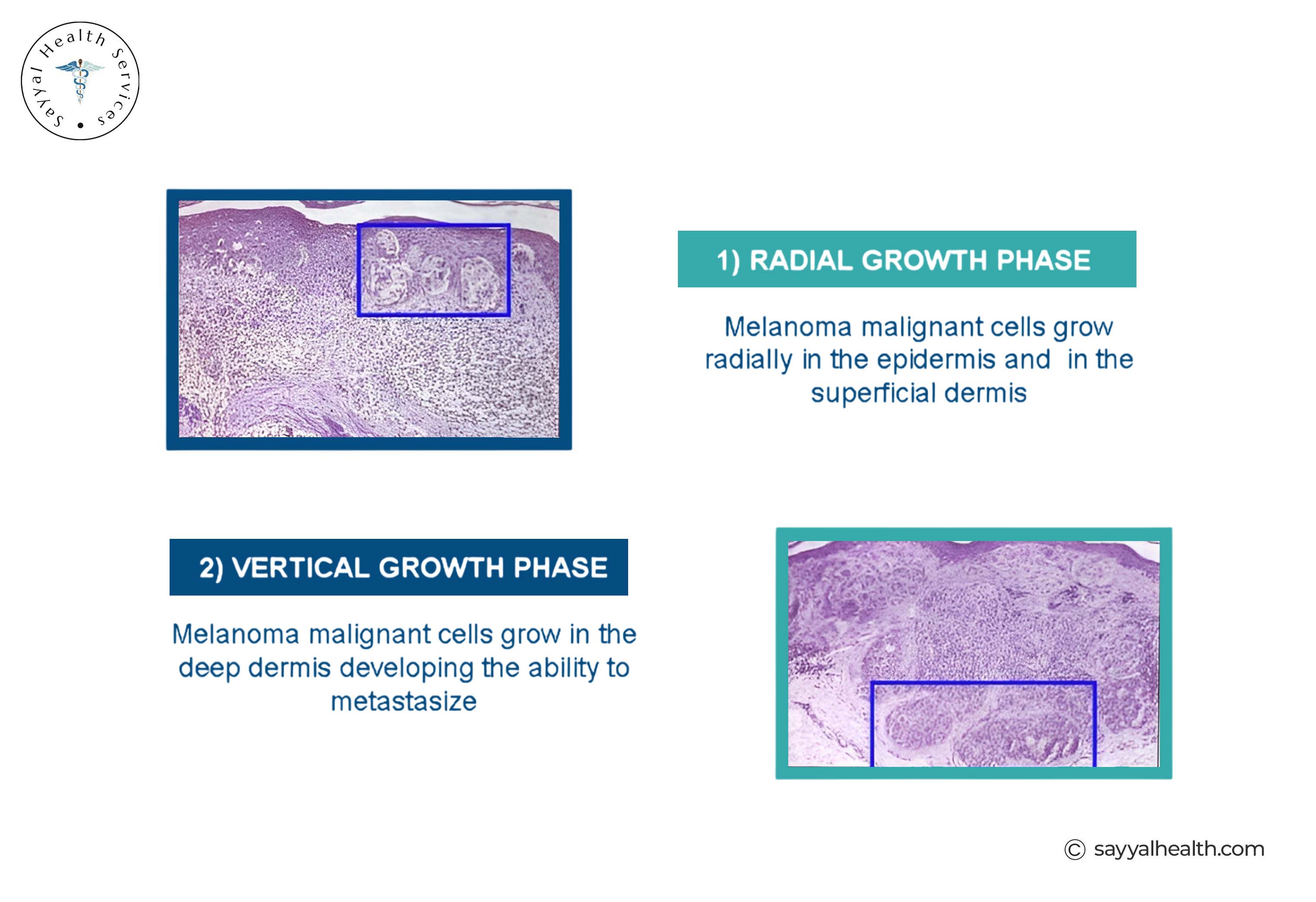 Acral Lentiginous Melanoma: Symptoms, Causes & Diagnosis